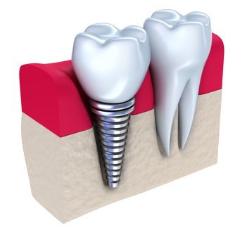 Round Rock Dental Implants