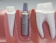 Round Rock Dental Implants